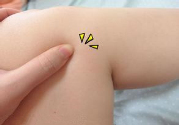 小腿水腫是什么原因引起的？教你輕松解決之道