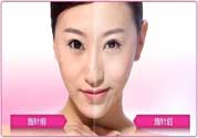 美白針真的有效嗎？美白針的危害有哪些？