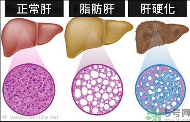 得了脂肪肝該怎么治？脂肪肝對人體危害有多大？