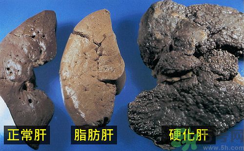 得了脂肪肝該怎么治？脂肪肝對人體危害有多大？