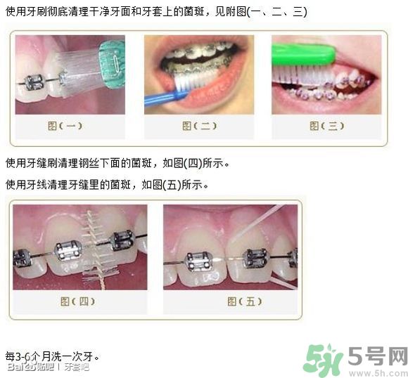 18歲還能戴牙套嗎？戴牙套真的能瘦臉改變臉型嗎？