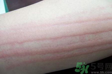蕁麻疹會不會傳染？蕁麻疹怎么治才能好？