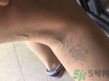 40歲女性小腿靜脈曲張怎么辦？