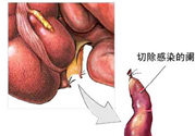 闌尾手術(shù)會(huì)影響結(jié)腸嗎？闌尾手術(shù)術(shù)后要注意什么？