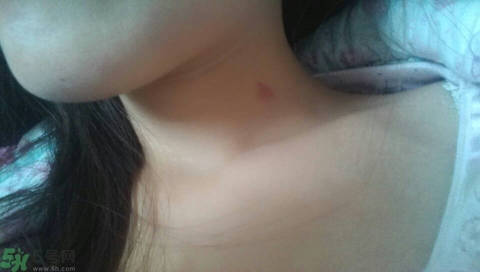 種草莓吻痕是什么意思？吻痕是怎么弄出來的？
