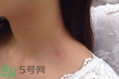 種草莓吻痕是什么意思？吻痕是怎么弄出來的？