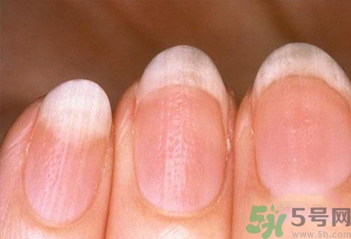 指甲發(fā)白是怎么回事？指甲發(fā)白代表什么？