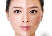 激光美白有用嗎？激光美白可以維持多久？