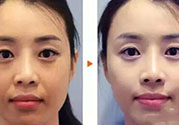 激光美白多少錢？激光美白價格