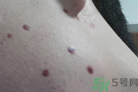 激光點痣后可以洗臉嗎？激光點痣后需要注意什么？