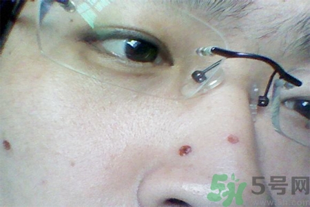 激光點痣后可以洗臉嗎？激光點痣后需要注意什么？
