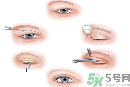 割雙眼皮分哪幾種？割雙眼皮需要多少錢？