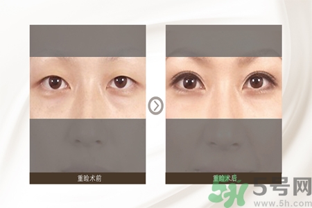 割雙眼皮分哪幾種？割雙眼皮需要多少錢？