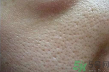 皮膚毛孔粗大原因有哪些？如何預(yù)防皮膚毛孔粗大？