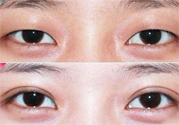 割雙眼皮分哪幾種？割雙眼皮需要多少錢？