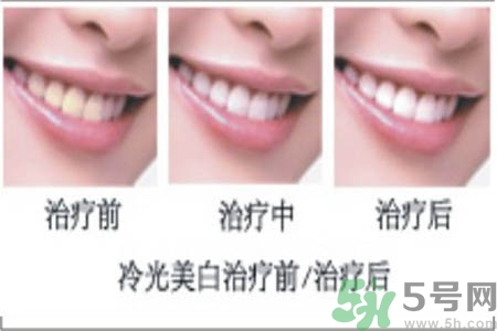 冷光美白牙齒是什么？冷光美白牙齒的好處有哪些？