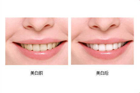 冷光美白牙齒可以保持多長(zhǎng)時(shí)間？冷光美白牙齒有副作用嗎？