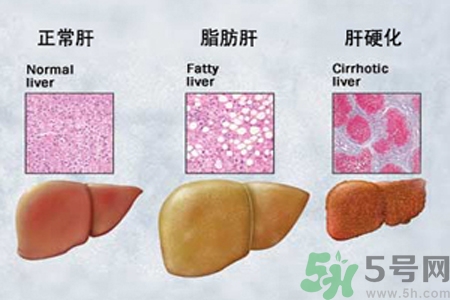 妊娠急性脂肪肝是什么？妊娠急性脂肪肝的治療方法？