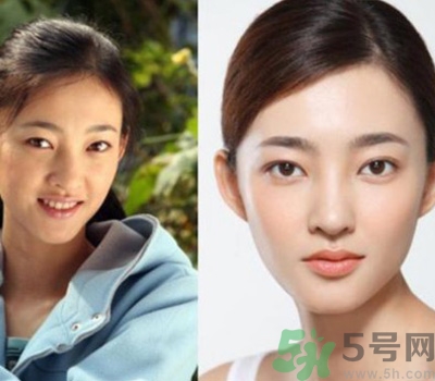 開眼角眼睛會(huì)變大嗎？開眼角眼睛能大多少？