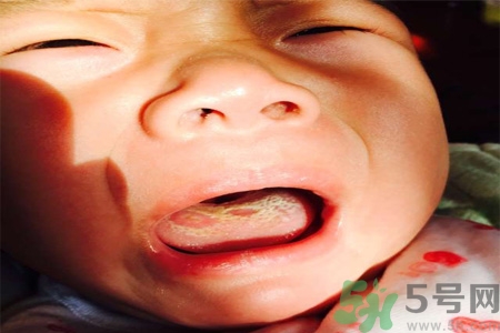 舌頭燙傷后該怎么辦呢？舌頭燙傷后應(yīng)該注意吃什么？?