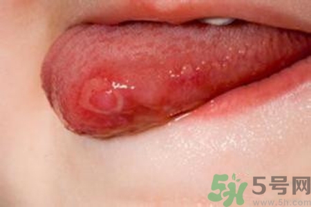 舌頭長(zhǎng)泡怎么辦？舌頭長(zhǎng)泡的原因？