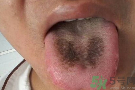 舌頭發(fā)黑怎么回事？舌頭發(fā)黑怎么辦？