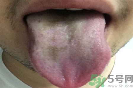 舌頭發(fā)黑怎么回事？舌頭發(fā)黑怎么辦？