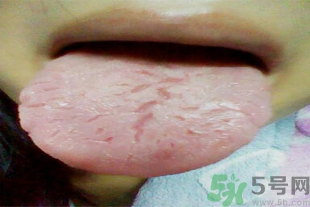 舌頭上有裂紋是怎么辦？舌頭上有裂紋是什么原因？