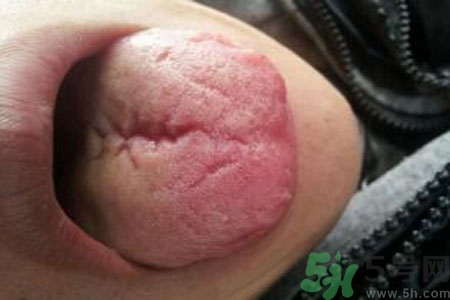 舌頭上有裂紋是怎么辦？舌頭上有裂紋是什么原因？