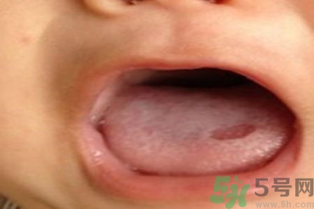 舌頭潰瘍怎么辦？舌頭潰瘍的原因？