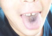 舌頭發(fā)黑怎么回事？舌頭發(fā)黑怎么辦？