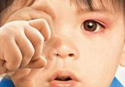寶寶得了紅眼病怎么辦？寶寶得了紅眼病怎么治？