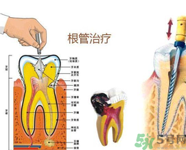 什么是根管治療？為什么牙齒疼要做根管治療？