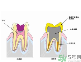 什么是根管治療？為什么牙齒疼要做根管治療？