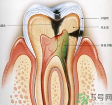 什么是根管治療？為什么牙齒疼要做根管治療？