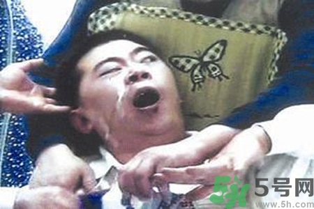 癲癇的典型癥狀有哪些？癲癇是什么？