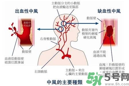 腦中風(fēng)是什么？腦中風(fēng)的癥狀？