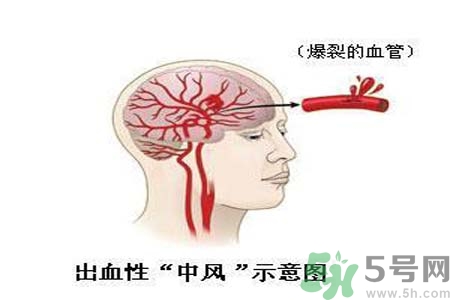 腦中風(fēng)的護(hù)理措施？腦中風(fēng)的飲食護(hù)理？
