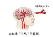 腦中風(fēng)的發(fā)病因素？腦中風(fēng)的并發(fā)癥有哪些 ？