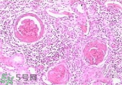 慢性腎炎能治好嗎？慢性腎炎能活多久？