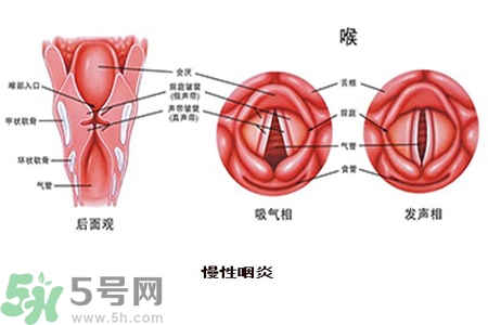 慢性咽炎是什么？慢性咽炎的癥狀有哪些？