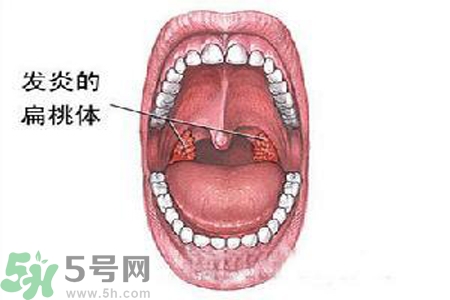 慢性咽炎是什么？慢性咽炎的癥狀有哪些？