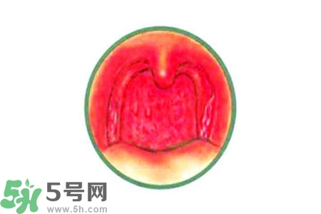 慢性咽炎的治療方法？慢性咽炎的藥物治療？