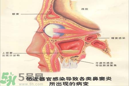 鼻竇炎是什么？鼻竇炎的癥狀有哪些？