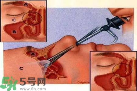 鼻竇炎的高發(fā)人群？如何預防鼻竇炎？