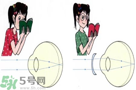 近視眼的發(fā)病因素？近視眼的并發(fā)癥有哪些？
