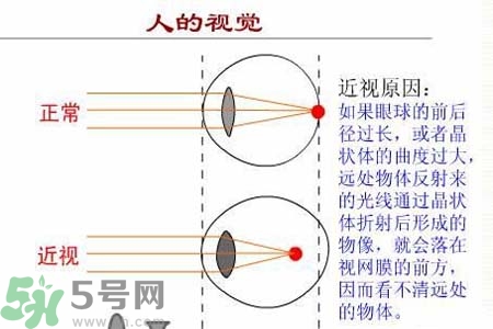 近視眼高發(fā)人群？如何預防近視眼？