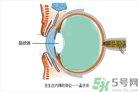 白內(nèi)障的護理措施是什么？白內(nèi)障的飲食護理有哪些？