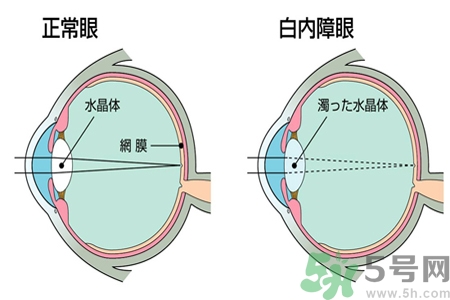 白內(nèi)障治療方法是什么？白內(nèi)障可以用什么藥物治療？