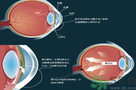 青光眼的高發(fā)人群有哪些？如何預(yù)防青光眼？